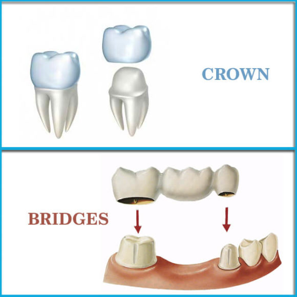 Crown and Bridge