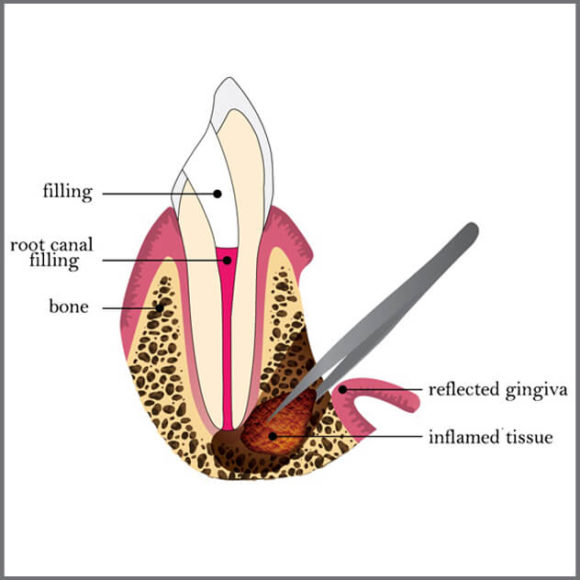 Endodontic Surgery