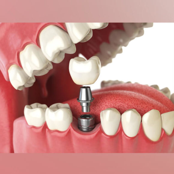Implants and Surgeries