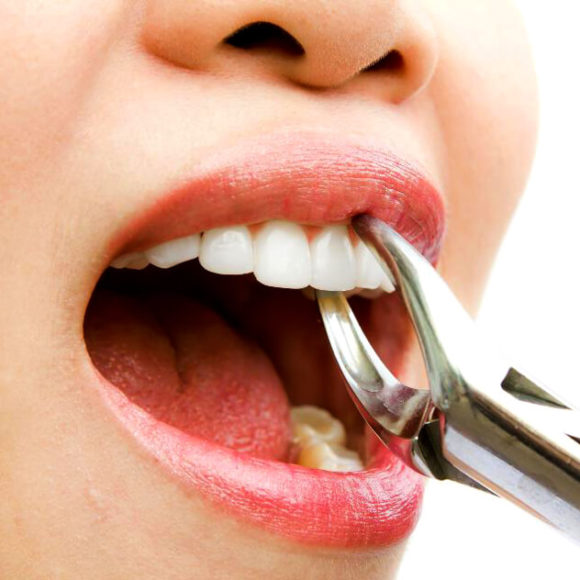Painless Dental Extractions