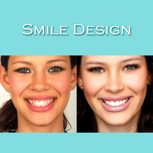 Smile Design