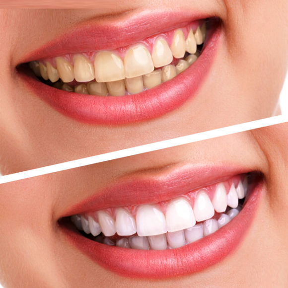 Teeth Whitening